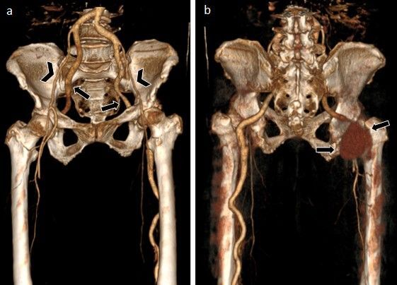 Case report: persistent bilateral complete sciatic artery associated with aneurysmal degeneration.