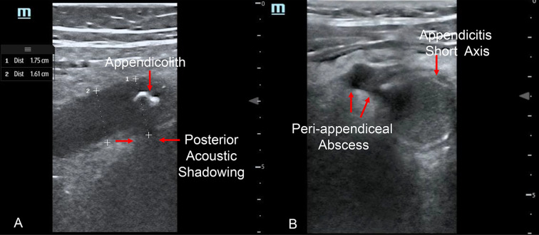 Interobserver agreement of an ED PoCUS video training dataset of normal appendix and appendicitis in children.
