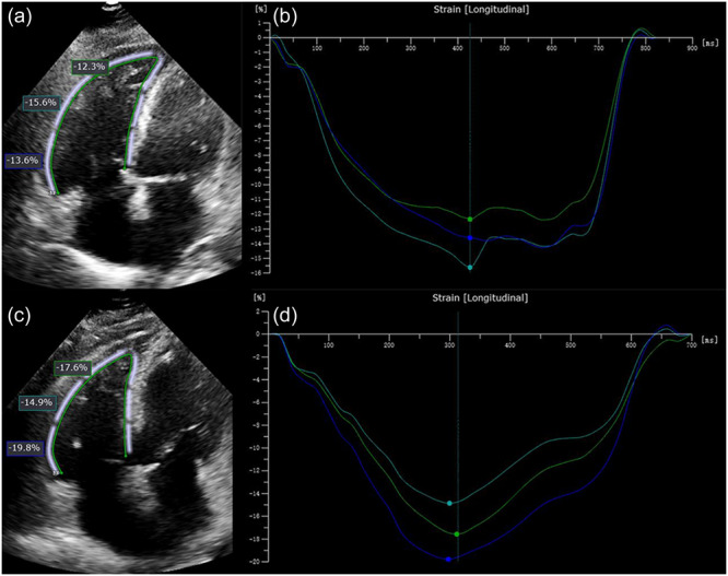 Better efficacy of sequential combination with balloon pulmonary angioplasty after long-term riociguat for patients with inoperable chronic thromboembolic pulmonary hypertension.