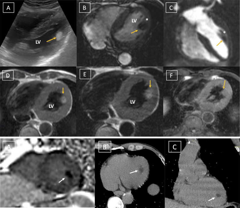 A Rare Case of Intracardiac Lipoma Arising from the Papillary Muscle.