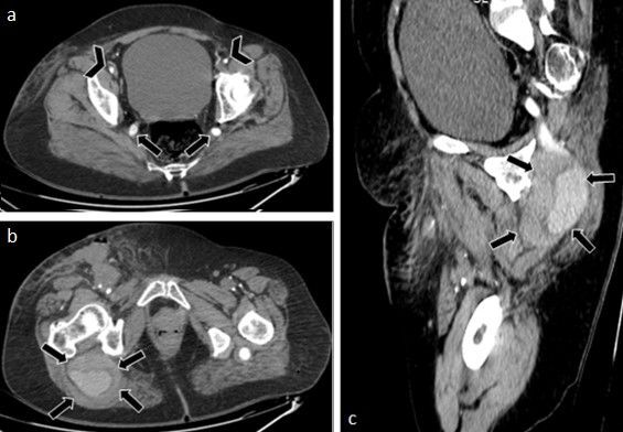 Case report: persistent bilateral complete sciatic artery associated with aneurysmal degeneration.
