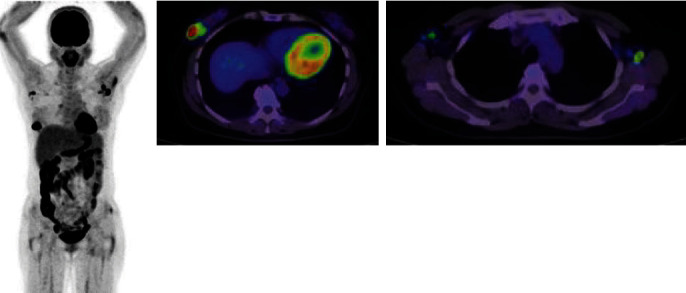 A Case of Autoimmune Neutropenia in a Patient Undergoing Breast Cancer Surgery.