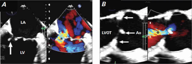 Valvular Endocarditis and Biventricular Heart Failure in the Setting of Tropheryma whipplei Disease.