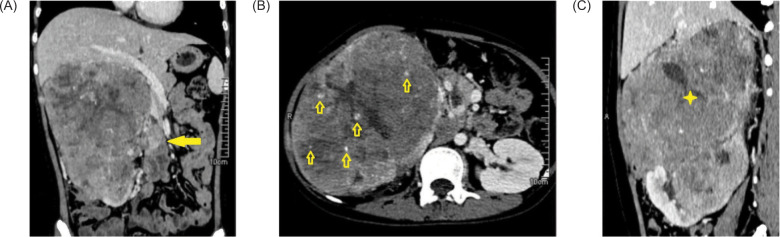 Approach to Diagnosis of TFE3-rearranged Renal Cell Carcinoma in a Limited Resource Setting: A Case Report.
