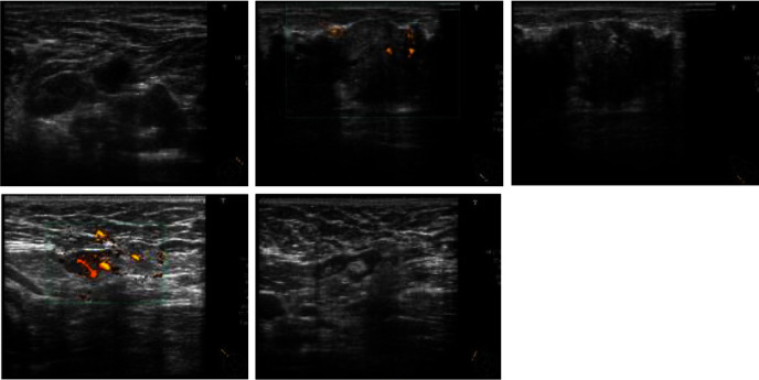 A Case of Autoimmune Neutropenia in a Patient Undergoing Breast Cancer Surgery.