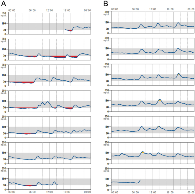 Insulinoma presenting with anti-insulin antibodies.