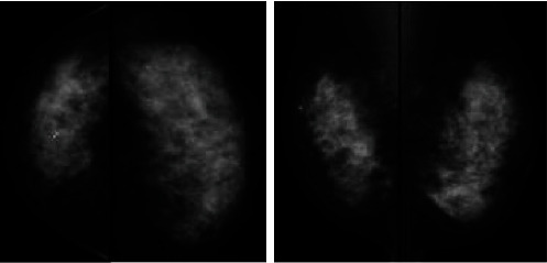 A Case of Autoimmune Neutropenia in a Patient Undergoing Breast Cancer Surgery.