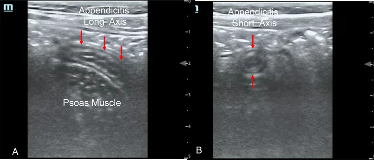 Interobserver agreement of an ED PoCUS video training dataset of normal appendix and appendicitis in children.