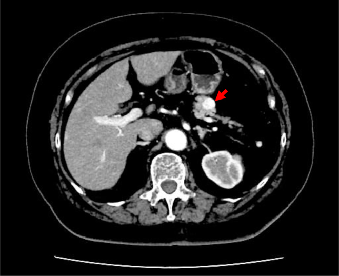 Insulinoma presenting with anti-insulin antibodies.