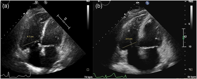 Better efficacy of sequential combination with balloon pulmonary angioplasty after long-term riociguat for patients with inoperable chronic thromboembolic pulmonary hypertension.