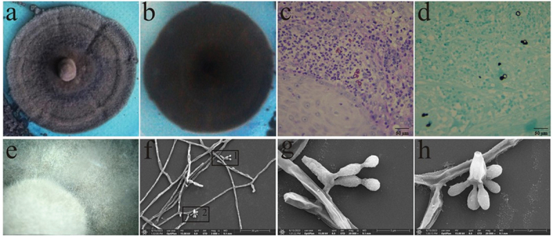 Improving treatment of chromoblastomycosis: the potential of COP1T-HA and antimicrobial photodynamic therapy against <i>Fonsecaea monophora in vitro</i>.