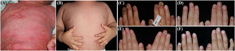 Etanercept: A viable treatment option for young children with generalized pustular psoriasis.