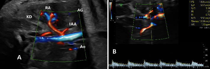 The Impact of Fetal Growth Restriction on Prenatal 2D Ultrasound and Doppler Study of the Fetal Adrenal Gland.