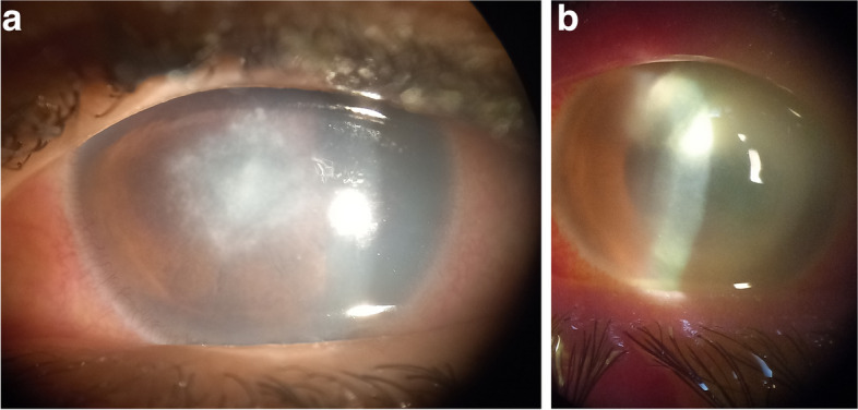 Impact of contact lens hygiene risk factors on the prevalence of contact lens-related keratitis in Alexandria-Egypt.
