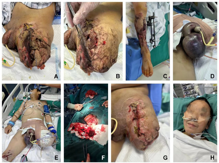 Navigating the 'Triangle of Death': A Multidisciplinary Approach in Severe Multi-Trauma Management.