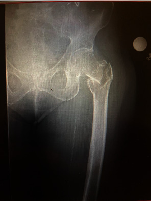 Traumatic Disruption of Profunda Femoris Artery Branch Following Treatment of an Intertrochanteric Hip Fracture With a Cephalomedullary Nail.