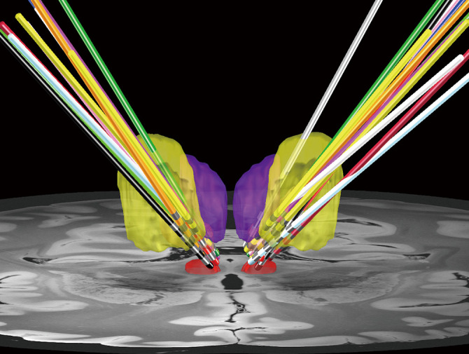 Surgical Concepts and Long-term Outcomes of Thalamic Deep Brain Stimulation in Patients with Severe Tourette Syndrome: A Single-center Experience.