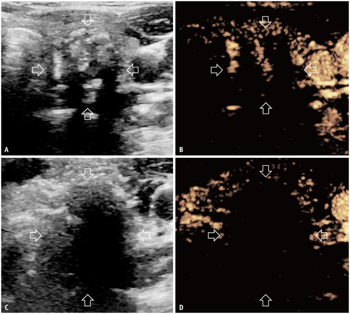 Efficacy and Safety of Thermal Ablation for Solitary Low-Risk T2N0M0 Papillary Thyroid Carcinoma.