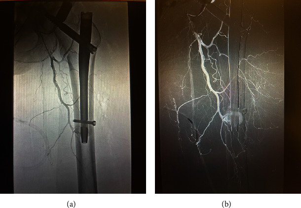 Traumatic Disruption of Profunda Femoris Artery Branch Following Treatment of an Intertrochanteric Hip Fracture With a Cephalomedullary Nail.