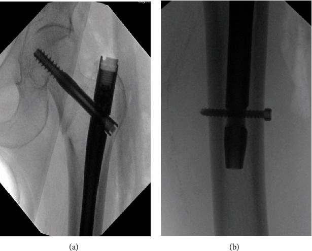 Traumatic Disruption of Profunda Femoris Artery Branch Following Treatment of an Intertrochanteric Hip Fracture With a Cephalomedullary Nail.