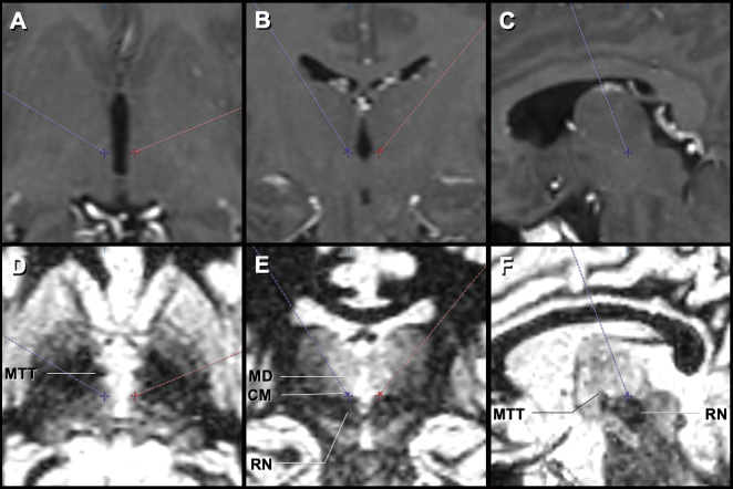 Surgical Concepts and Long-term Outcomes of Thalamic Deep Brain Stimulation in Patients with Severe Tourette Syndrome: A Single-center Experience.