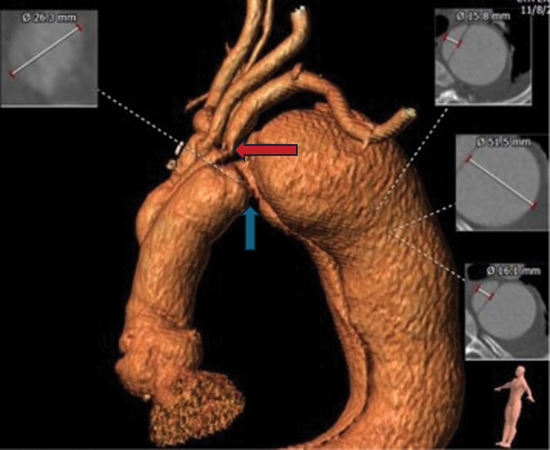 Delayed Paraplegia after Complex Repair of Thoracic Aortic Dissection.