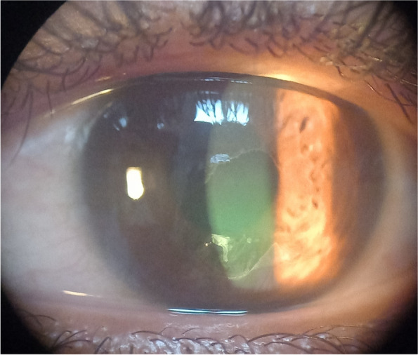 Impact of contact lens hygiene risk factors on the prevalence of contact lens-related keratitis in Alexandria-Egypt.