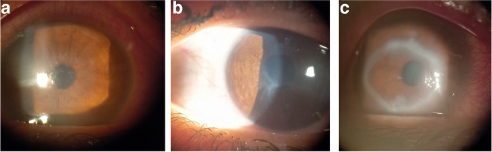 Impact of contact lens hygiene risk factors on the prevalence of contact lens-related keratitis in Alexandria-Egypt.
