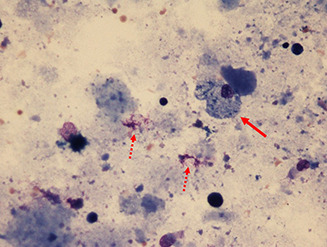 Pathogenesis-driven treatment of primary pulmonary alveolar proteinosis.