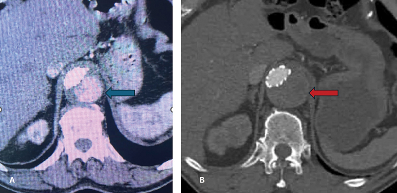 Delayed Paraplegia after Complex Repair of Thoracic Aortic Dissection.