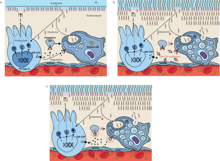 Pathogenesis-driven treatment of primary pulmonary alveolar proteinosis.