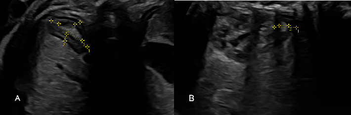 The Impact of Fetal Growth Restriction on Prenatal 2D Ultrasound and Doppler Study of the Fetal Adrenal Gland.