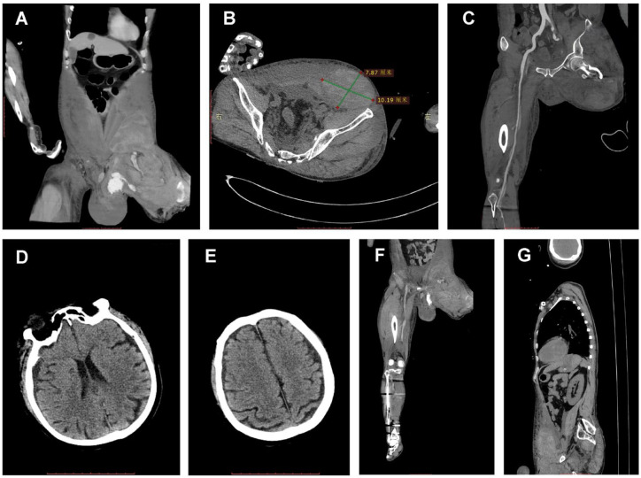 Navigating the 'Triangle of Death': A Multidisciplinary Approach in Severe Multi-Trauma Management.