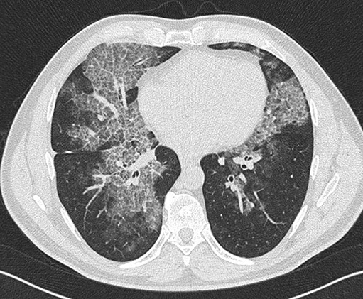 Pathogenesis-driven treatment of primary pulmonary alveolar proteinosis.