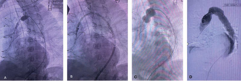 Delayed Paraplegia after Complex Repair of Thoracic Aortic Dissection.