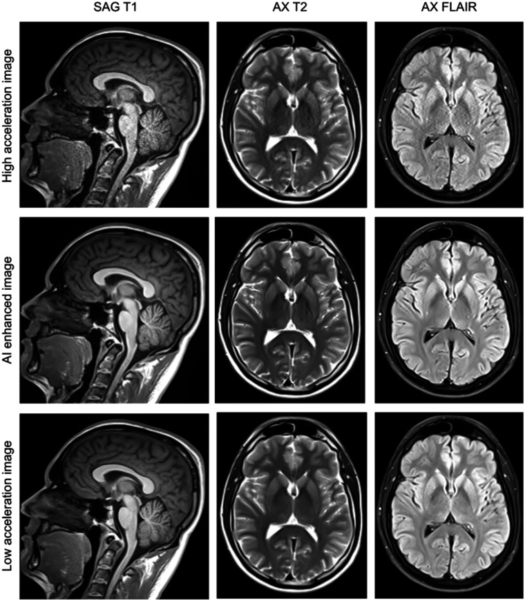 An image-domain deep-learning denoising technique for accelerated parallel brain MRI: prospective clinical evaluation.