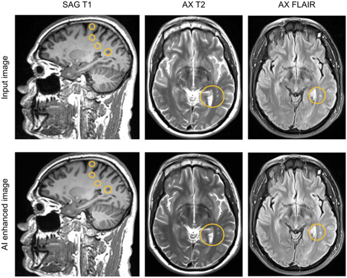 An image-domain deep-learning denoising technique for accelerated parallel brain MRI: prospective clinical evaluation.