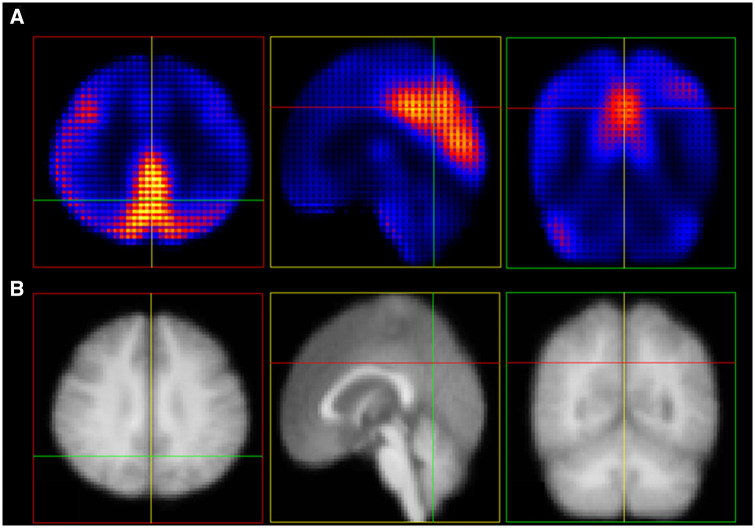 <sup>18</sup>F-FDG-PET-based deep learning for predicting cognitive decline in non-demented elderly across the Alzheimer's disease clinical spectrum.
