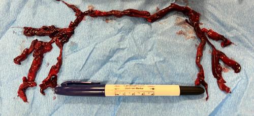 Man with convulsive syncope