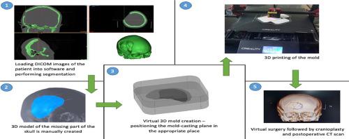 From imaging to personalized 3D printed molds in cranioplasty