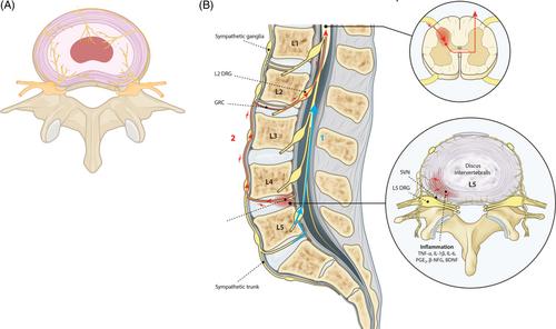 Biomolecular therapies for chronic discogenic low back pain: A narrative review