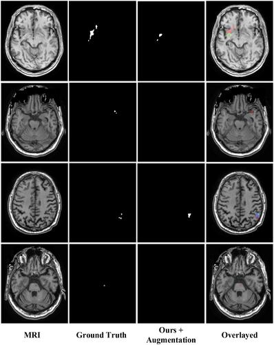 Segmentation of stroke lesions using transformers-augmented MRI analysis