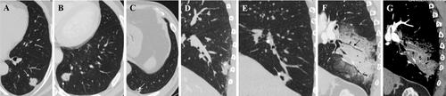 Radiological Features of Primary Pulmonary Invasive Mucinous Adenocarcinoma Based on 312 Consecutive Patients