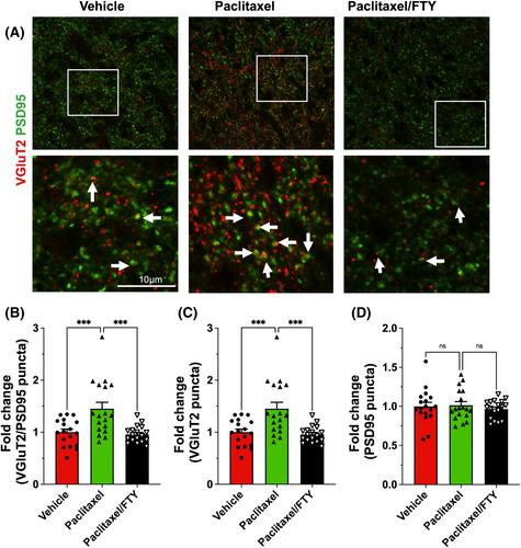 FTY720/Fingolimod mitigates paclitaxel-induced Sparcl1-driven neuropathic pain and breast cancer progression