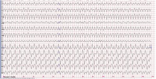 Rare Presentation of Wide QRS Tachycardia in a Patient in Their 40s