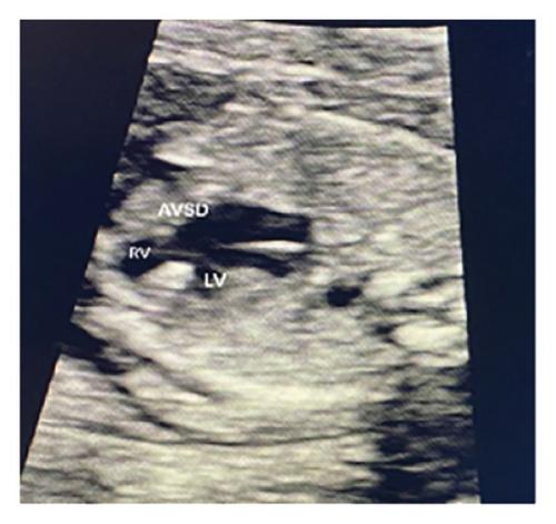 Evaluation of Atrioventricular Valve Regurgitation in Detection of Atrioventricular Septal Defects at First Trimester Ultrasound