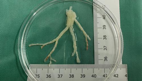 Distinct clinical characteristics of bocavirus and Mycoplasma pneumoniae infection in children plastic bronchitis