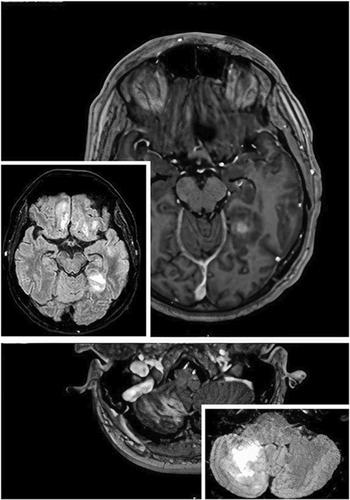 Multiple intra-axial lesions in a 57-year-old male with a history of B-cell chronic lymphocytic leukemia