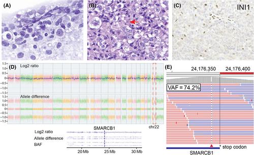 A pituitary mass in a 46-year-old woman