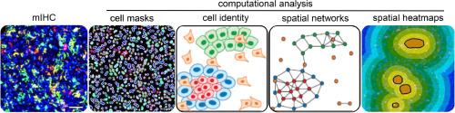 Navigating the immunosuppressive brain tumor microenvironment using spatial biology